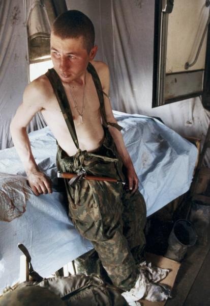 Солдат с обмороженными ногами в госпитале, 1999 год, Чеченская Республика. 7 августа 1999 года началась Вторая чеченская война. Активная фаза боевых действий продолжалась с 1999 года по 2000 год.